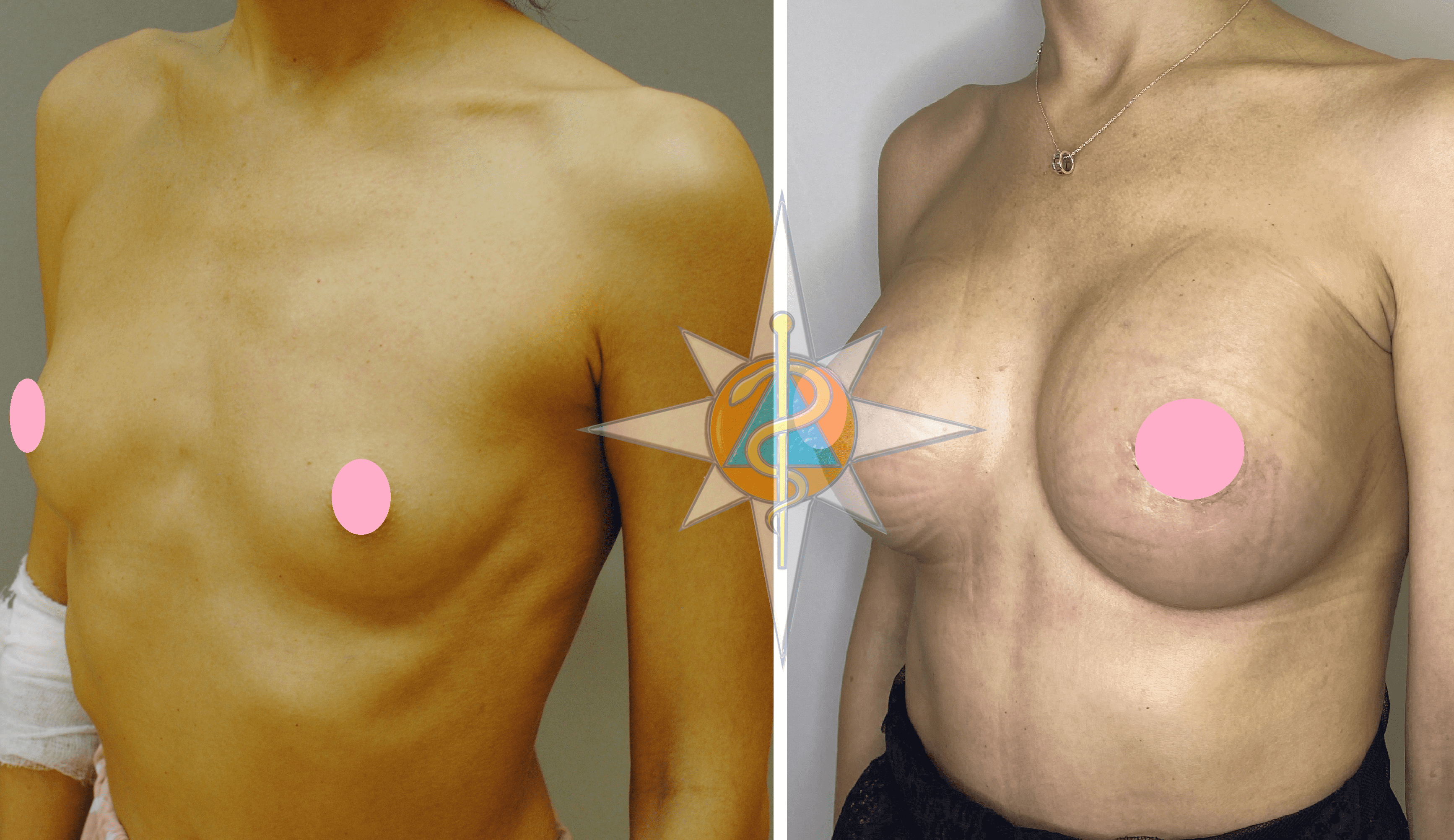может ли при мастопатии увеличиться одна грудь фото 110